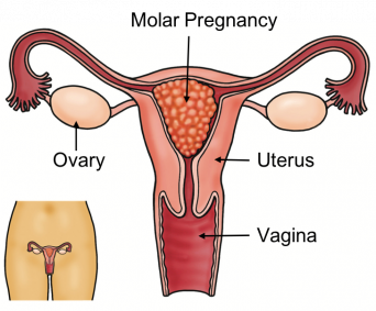 MOLAR PREGNANCY